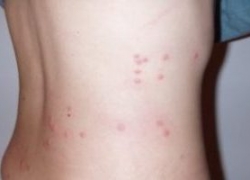 La piqûre de puce de lit